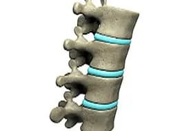Critical Meaning of Vertebra Fracture – Watch WebMD Video
