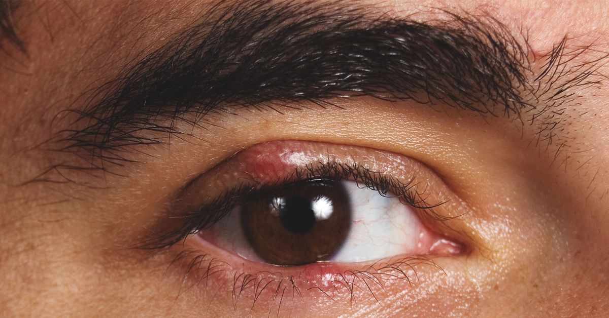 Are Styes Contagious? Causes, Prevention, and More