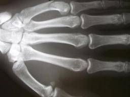 Boxer’s Fracture: Treatment, Diagnosis, and Recovery