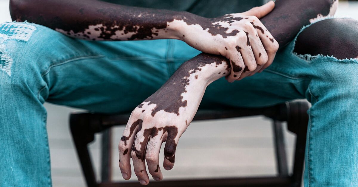 Vitiligo and Psoriasis: Is There a Connection?