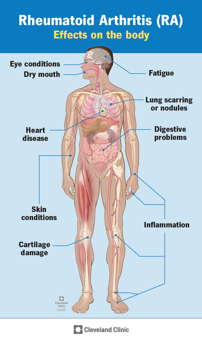 Rheumatoid Arthritis (RA): Symptoms, Stages & Treatment