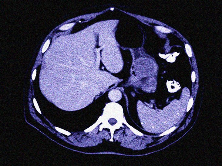 Gastrointestinal Stromal Tumor (GIST): Symptoms, Treatment, Outlook