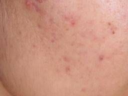 Acne: Causes, Treatment, and Tips