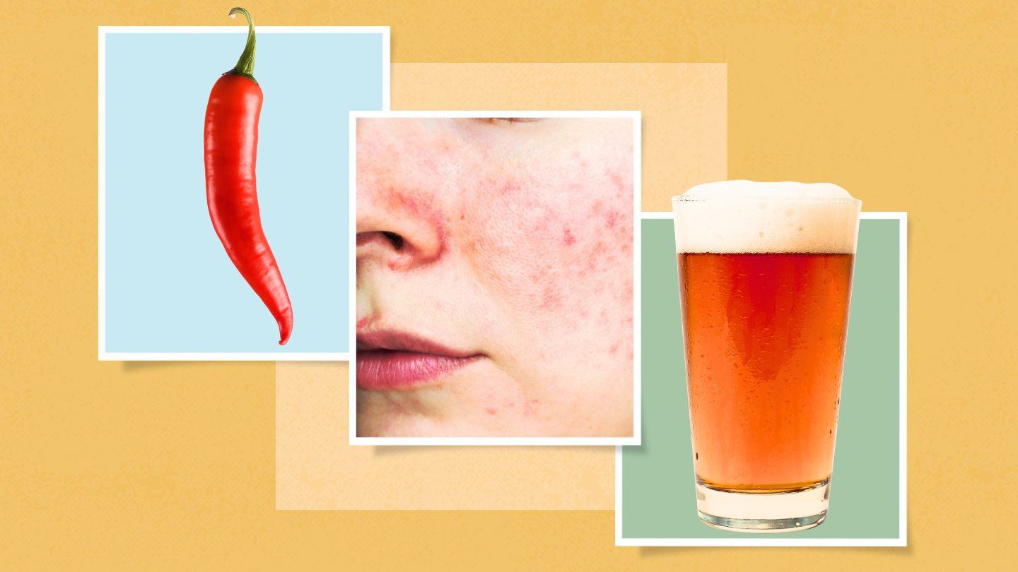 10 Top Rosacea Triggers and How to Tame Them