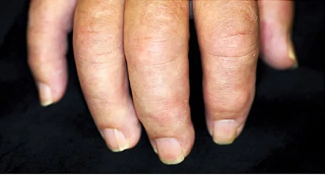 What Psoriatic Arthritis Does to Your Body Explained