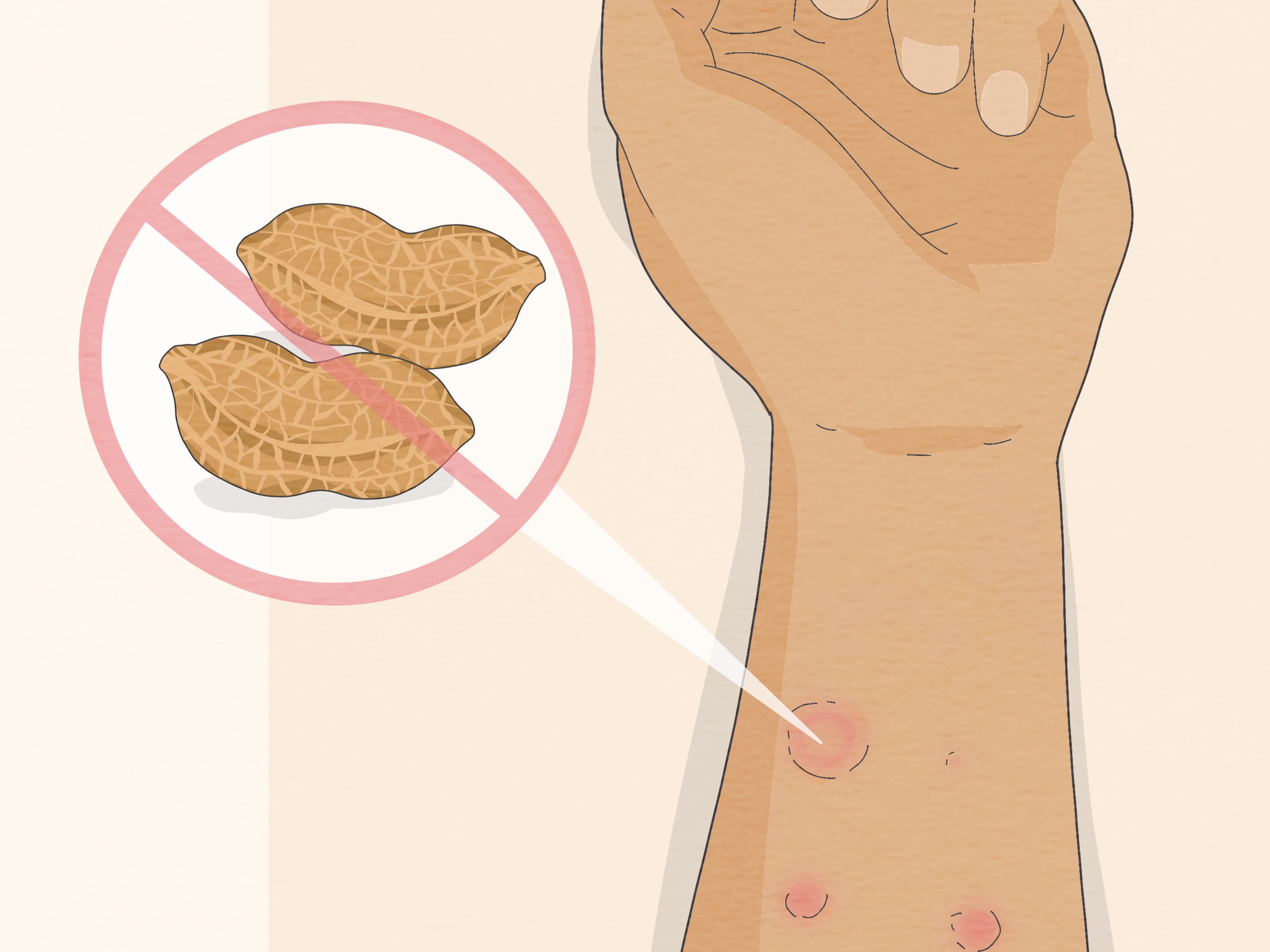 3 Ways to Read Allergy Skin Test Results