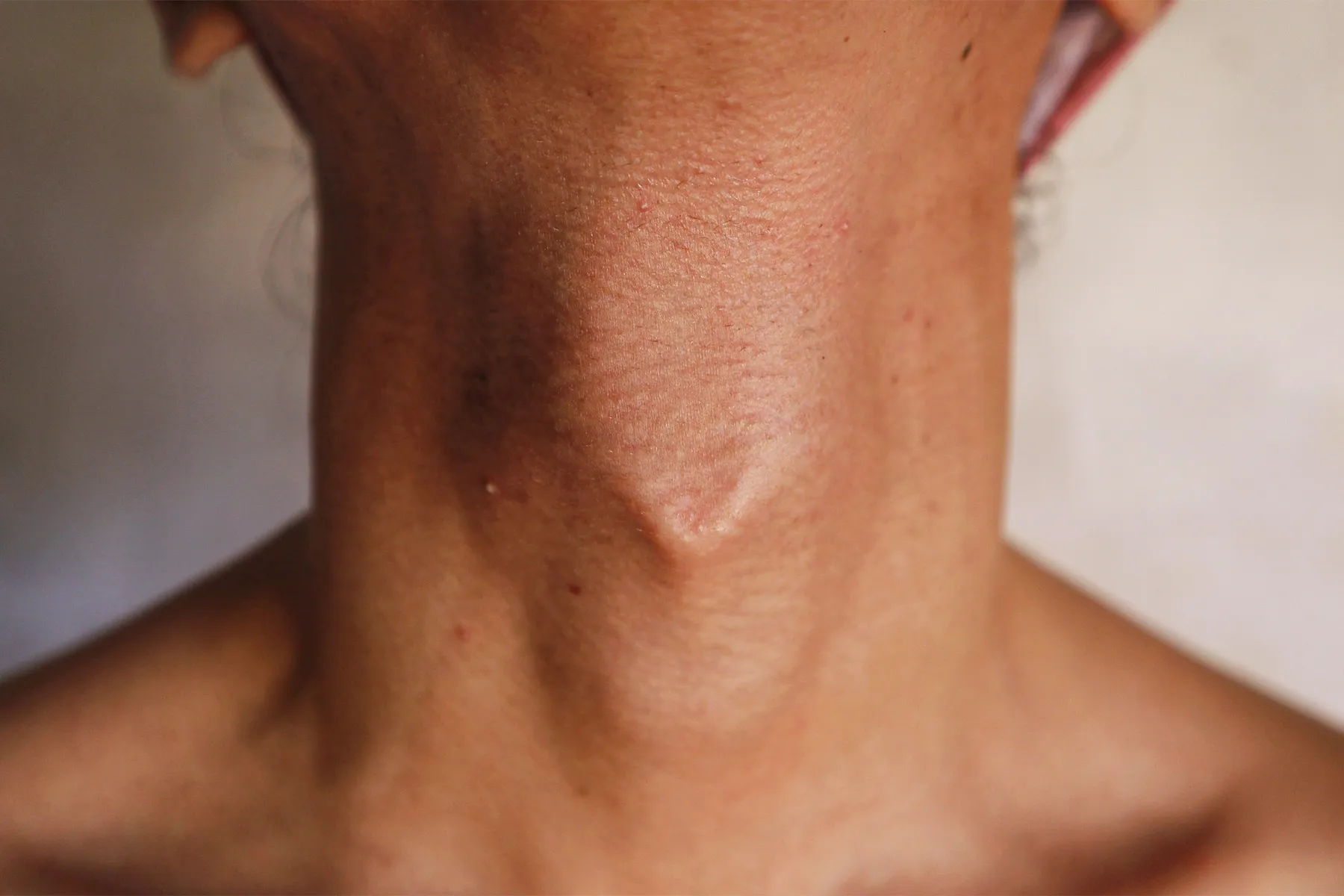 Adam’s Apple: How it Develops & Surgical Options